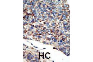 Formalin-fixed and paraffin-embedded human hepatocellular carcinoma tissue reacted with PIK3C2G polyclonal antibody  , which was peroxidase-conjugated to the secondary antibody, followed by AEC staining. (PIK3C2G antibody  (N-Term))