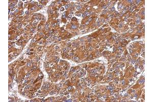 IHC-P Image Immunohistochemical analysis of paraffin-embedded human hepatoma, using MMP8, antibody at 1:500 dilution. (MMP8 antibody)