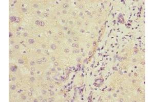 Immunohistochemistry of paraffin-embedded human liver cancer using ABIN7148298 at dilution of 1:100 (COMMD1 antibody  (AA 1-190))