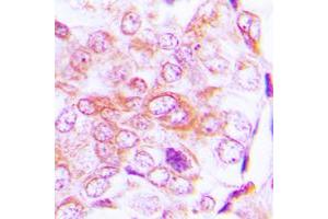 Immunohistochemical analysis of BMP5 staining in human lung cancer formalin fixed paraffin embedded tissue section. (BMP5 antibody  (Center))