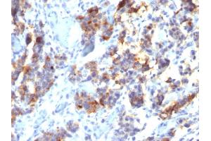 Formalin-fixed, paraffin-embedded human Gastric Carcinoma stained with MUC5AC Mouse Monoclonal Antibody (45M1). (MUC5AC antibody)