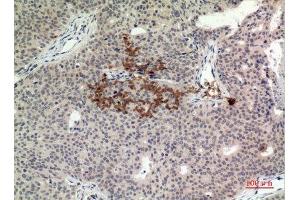 Immunohistochemistry (IHC) analysis of paraffin-embedded Human Breast Cancer, antibody was diluted at 1:100.