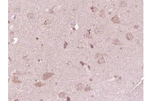 Paraformaldehyde-fixed, paraffin embedded human glioma, Antigen retrieval by boiling in sodium citrate buffer (pH6) for 15min, Block endogenous peroxidase by 3% hydrogen peroxide for 30 minutes, Blocking buffer (normal goat serum) at 37°C for 20min, Antibody incubation with ATP7A Polyclonal Antibody  at 1:400 overnight at 4°C, followed by a conjugated secondary and DAB staining. (ATP7A antibody  (AA 242-285))