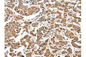 The image on the left is immunohistochemistry of paraffin-embedded Human breast cancer tissue using ABIN7189774(ALDH9A1 Antibody) at dilution 1/50, on the right is treated with synthetic peptide. (ALDH9A1 antibody)