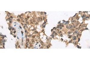 Immunohistochemistry of paraffin-embedded Human ovarian cancer tissue using ATRX Polyclonal Antibody at dilution of 1:50(x200) (ATRX antibody)