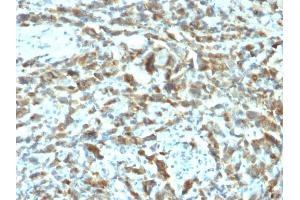 Formalin-fixed, paraffin-embedded human Breast Carcinoma stained with TFF1/pS2 Mouse Monoclonal Antibody (TFF1/2133). (TFF1 antibody)