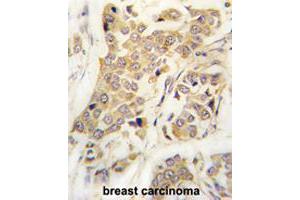 Formalin-fixed and paraffin-embedded human breast carcinomareacted with CDH8 polyclonal antibody , which was peroxidase-conjugated to the secondary antibody, followed by AEC staining.