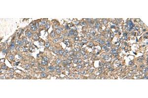 Immunohistochemistry of paraffin-embedded Human liver cancer tissue using RPS14 Polyclonal Antibody at dilution of 1:50(x200) (RPS14 antibody)