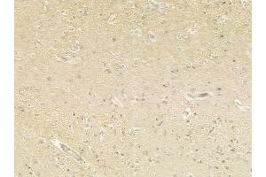 ABIN6260529 and ABIN6279318 at 1/100 staining human glioblastoma by IHC-P.