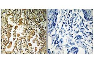 Immunohistochemistry analysis of paraffin-embedded human lung carcinoma tissue using SF3B4 antibody. (SF3B4 antibody  (Internal Region))
