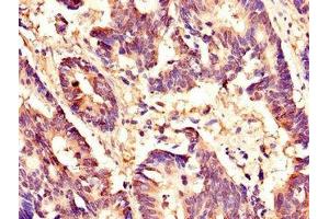 Immunohistochemistry of paraffin-embedded human colon cancer using ABIN7155909 at dilution of 1:100 (HCFC1 antibody  (AA 201-428))