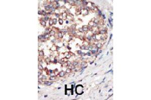 Formalin-fixed and paraffin-embedded human hepatocellular carcinoma tissue reacted with PIK3CG polyclonal antibody  , which was peroxidase-conjugated to the secondary antibody, followed by AEC staining. (PIK3 gamma antibody  (C-Term))