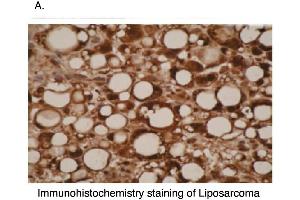 Immunohistochemical staining of liposarcoma cells using CYP26A1  antibody . (CYP26A1 antibody  (C-Term))