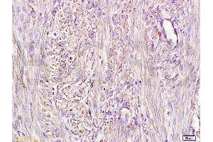 Immunohistochemistry (IHC) image for anti-alpha-Fetoprotein (AFP) antibody (ABIN722916) (alpha Fetoprotein antibody)