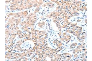 The image on the left is immunohistochemistry of paraffin-embedded Human lung cancer tissue using ABIN7128233(ADAM21 Antibody) at dilution 1/15, on the right is treated with fusion protein. (ADAM21 antibody)