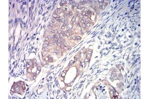 Immunohistochemical analysis of paraffin-embedded cervical cancer tissues using ACSS1 mouse mAb with DAB staining. (ACSS1 antibody  (AA 548-689))