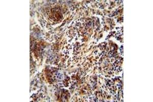 ZNF30 antibody (N-term) immunohistochemistry analysis in formalin fixed and paraffin embedded human lung carcinoma followed by peroxidase conjugation of the secondary antibody and DAB staining. (ZFP30 antibody  (N-Term))