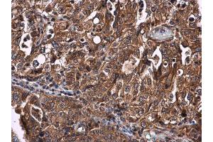 IHC-P Image CYP27A1 antibody detects CYP27A1 protein at cytoplasm in human endometrial carcinoma by immunohistochemical analysis. (CYP27A1 antibody  (Center))