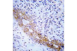 Immunohistochemical analysis of paraffin- embedded human breast carcinoma tissue using FLT3 (Ab-591) Antibody (E022078). (FLT3 antibody)