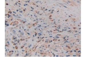 IHC-P analysis of Human Prostate Gland Cancer Tissue, with DAB staining. (Lipocalin 2 antibody  (AA 21-198))