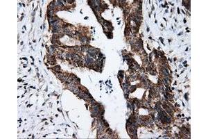 Immunohistochemical staining of paraffin-embedded Adenocarcinoma of colon tissue using anti-FKBP1A mouse monoclonal antibody. (FKBP1A antibody)