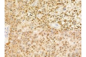 ABIN6257903 and ABIN6275344 at 1/100 staining human hepatocellular carcinoma by IHC-P.
