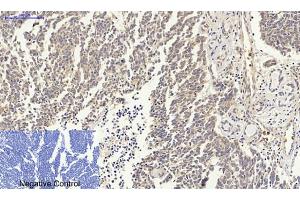 Immunohistochemical analysis of paraffin-embedded human lung cancer tissue. (p53 antibody)