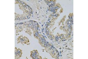 Immunohistochemistry of paraffin-embedded human prostate using PSAT1 Antibody (ABIN6293473) at dilution of 1:100 (40x lens).