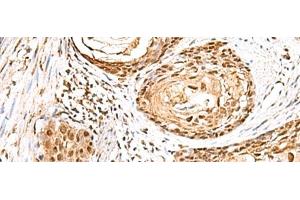 Immunohistochemistry of paraffin-embedded Human esophagus cancer tissue using ELF3 Polyclonal Antibody at dilution of 1:95(x200) (ELF3 antibody)
