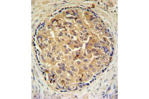 SRD5A3 Antibody IHC analysis in formalin fixed and paraffin embedded human prostate carcinoma followed by peroxidase conjugation of the secondary antibody and DAB staining. (SRD5A3 antibody  (C-Term))
