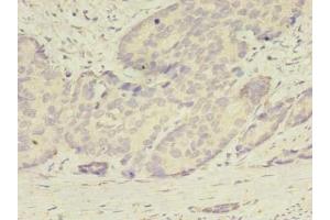 Immunohistochemistry of paraffin-embedded human gastric cancer using ABIN7145113 at dilution of 1:100 (ATG2B antibody  (AA 1357-1536))