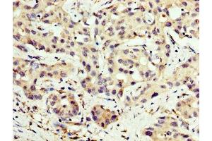 IHC image of ABIN7146841 diluted at 1:200 and staining in paraffin-embedded human liver cancer performed on a Leica BondTM system. (CPT2 antibody  (AA 388-551))