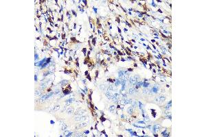 Immunohistochemistry of paraffin-embedded human colon carcinoma using FSP1/S100 Rabbit mAb (ABIN7270125) at dilution of 1:100 (40x lens).