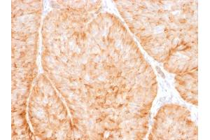 Formalin-fixed, paraffin-embedded human Bladder carcinoma stained withGLUT-1 Mouse Monoclonal Antibody (GLUT1/2475).