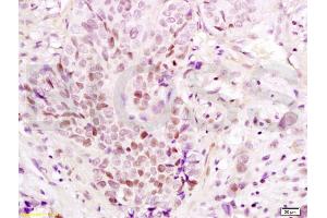 Formalin-fixed and paraffin embedded human esophageal carcinoma labeled with Anti-PAX3 Polyclonal Antibody, Unconjugated (ABIN737616) at 1:200 followed by conjugation to the secondary antibody and DAB staining (Paired Box 3 antibody  (AA 151-250))