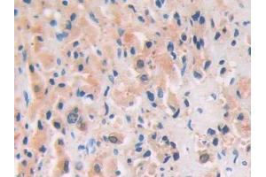 DAB staining on IHC-P; Samples: Human Prostate cancer Tissue (PRSS8 antibody  (AA 33-218))