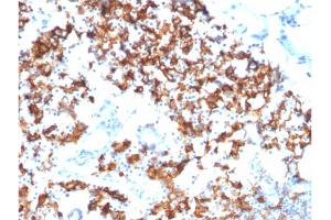 Formalin-fixed, paraffin-embedded human Gastric Carcinoma stained with IL3RA/CD123 Mouse Monoclonal Antibody (IL3RA/1531). (IL3RA antibody  (AA 26-171))