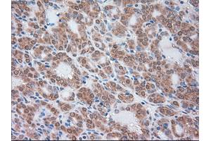Immunohistochemical staining of paraffin-embedded Carcinoma of liver tissue using anti-SERPINA1mouse monoclonal antibody. (SERPINA1 antibody)