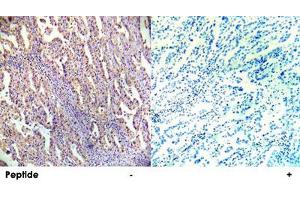 Immunohistochemical analysis of paraffin-embedded human lung carcinoma tissue using PRKAB1 polyclonal antibody . (PRKAB1 antibody  (Ser182))