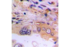 Immunohistochemical analysis of EEF2K staining in human lung cancer formalin fixed paraffin embedded tissue section. (EEF2K antibody  (Center))