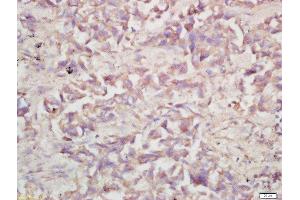 Formalin-fixed and paraffin embedded human lung carcinoma labeled with Rabbit Anti-V-ATPase A1 Polyclonal Antibody, Unconjugated (ABIN1387667) at 1:200 followed by conjugation to the secondary antibody and DAB staining (V-ATPase 116 kDa Isoform a1 (AA 41-140) antibody)