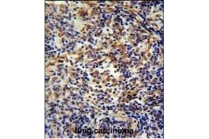 CASKIN2 Antibody (Center) (ABIN654902 and ABIN2844550) immunohistochemistry analysis in formalin fixed and paraffin embedded human lung carcinoma followed by peroxidase conjugation of the secondary antibody and DAB staining. (CASKIN2 antibody  (AA 714-741))