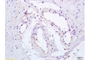 Formalin-fixed and paraffin embedded human gastric carcinoma labeled with Anti-Phospho-PPAR Gamma(ser112) Polyclonal Antibody, Unconjugated (ABIN703405) at 1:200, followed by conjugation to the secondary antibody and DAB staining (PPARG antibody  (pSer112))