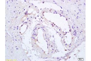Formalin-fixed and paraffin embedded human gastric carcinoma labeled with Anti-Phospho-PPAR Gamma(ser112) Polyclonal Antibody, Unconjugated (ABIN703405) at 1:200, followed by conjugation to the secondary antibody and DAB staining