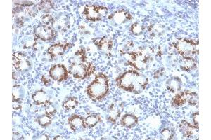 Formalin-fixed, paraffin-embedded human Gastric Carcinoma stained with SOX9 Mouse Monoclonal Antibody (SOX9/2387). (SOX9 antibody  (AA 393-508))