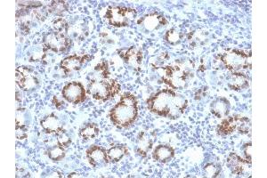 Formalin-fixed, paraffin-embedded human Gastric Carcinoma stained with SOX9 Mouse Monoclonal Antibody (SOX9/2387).