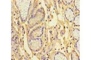 Immunohistochemistry of paraffin-embedded human gastric cancer using ABIN7163422 at dilution of 1:100 (ANKRD33 antibody  (AA 1-272))
