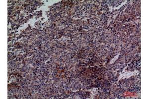 Immunohistochemistry (IHC) analysis of paraffin-embedded Human Lung Cancer, antibody was diluted at 1:100.