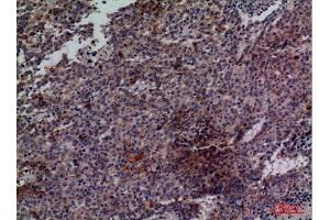 Immunohistochemistry (IHC) analysis of paraffin-embedded Human Lung Cancer, antibody was diluted at 1:100. (CDC34 antibody  (Internal Region))
