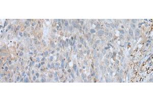 Immunohistochemistry of paraffin-embedded Human lung cancer tissue using VWA2 Polyclonal Antibody at dilution of 1:45(x200) (VWA2 antibody)